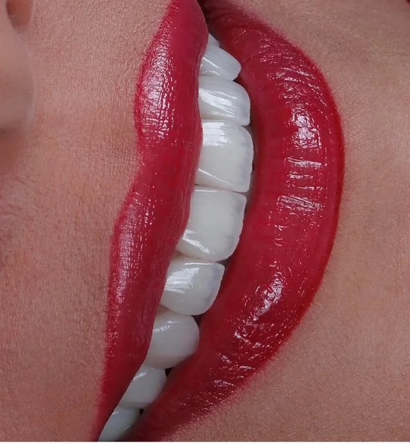 After treatment: a profile view showcasing the precise contouring and bright, lifelike translucency achieved following professional teeth whitening and conservative cosmetic reshaping.